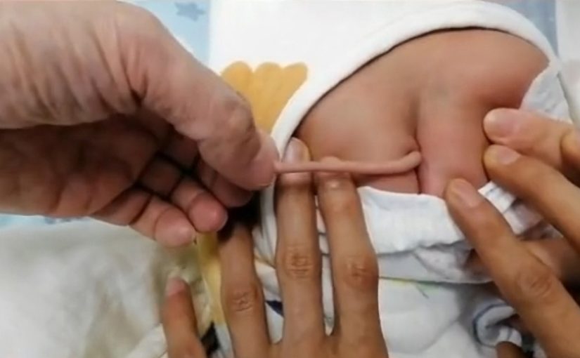 Немовля народилося з десятисантиметровим хвостиком: фото ➤ Prozoro.net.ua
