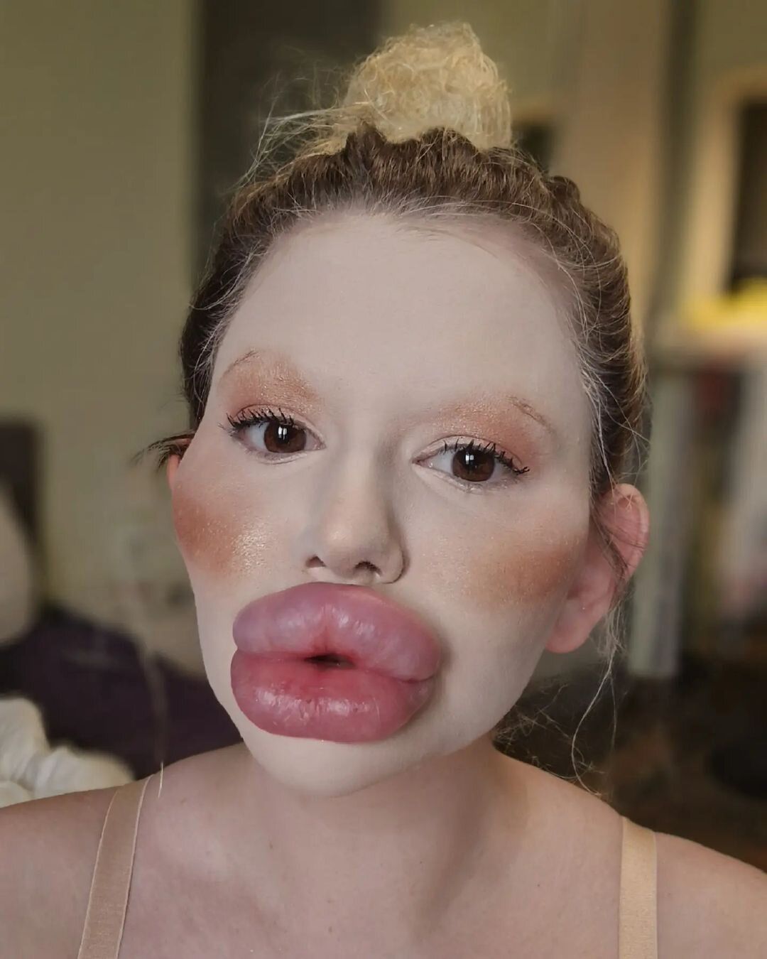 Жінка з найбільшими губами у світі зробила нові ін’єкції: фото  