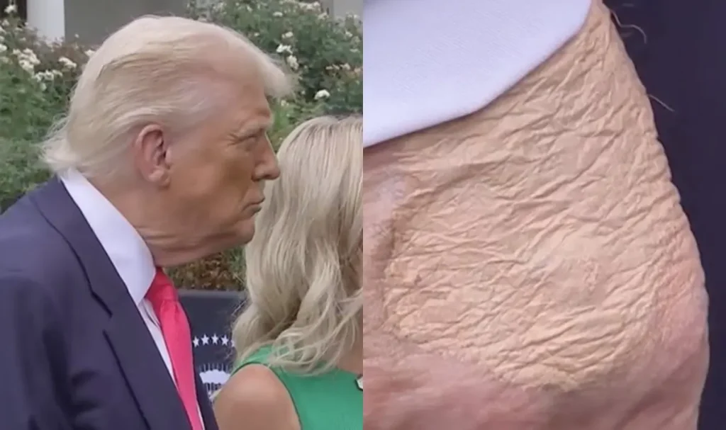 Трамп,Яка хвороба у Трампа,Рука Дональда Трампа із синцем,венозна недостатність Трамп Яка хвороба у Трампа