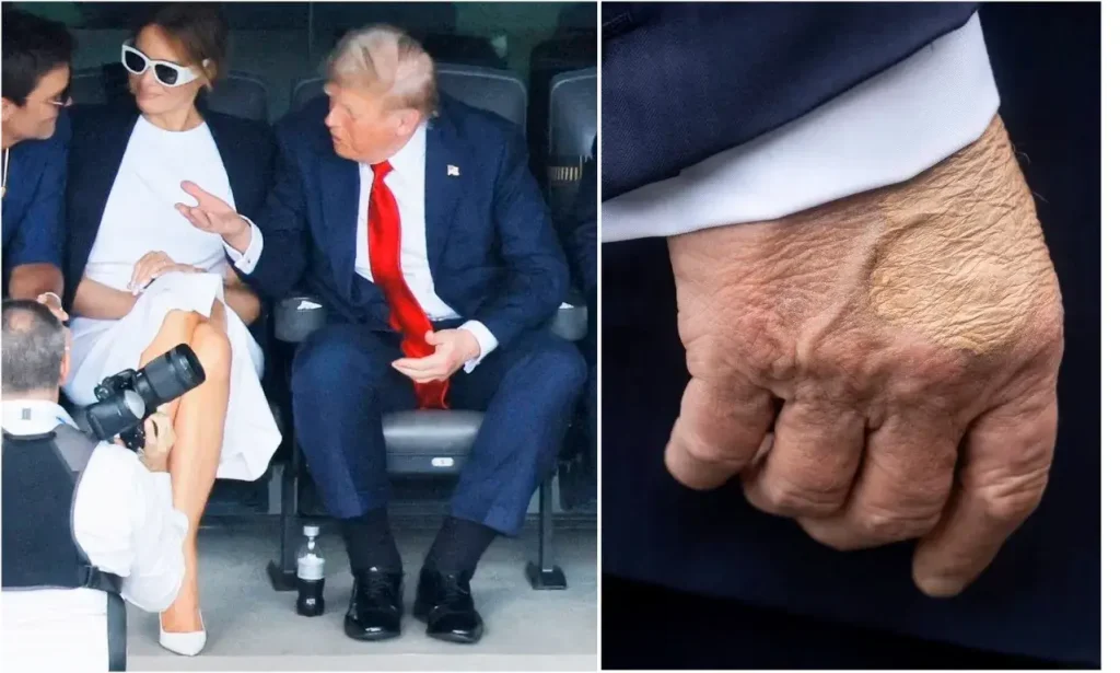 Трамп,Яка хвороба у Трампа,Рука Дональда Трампа із синцем,венозна недостатність Трамп Яка хвороба у Трампа